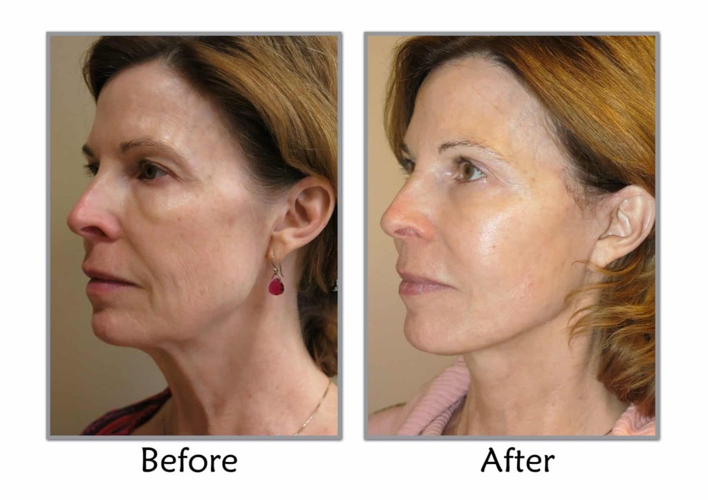 Why facelifts are still a top choice for timeless beauty